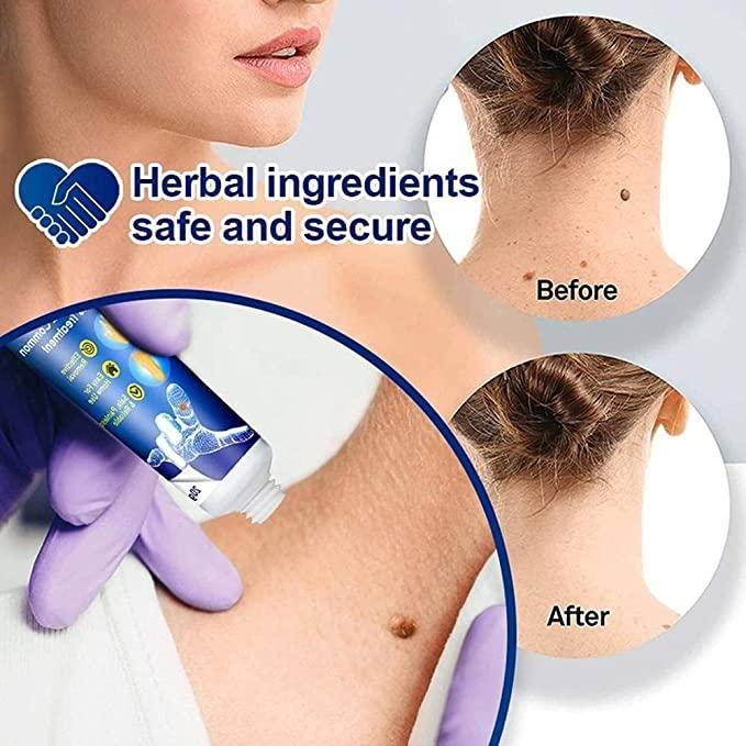 WartsOff Instant Blemish Removal Cream Pack of 1