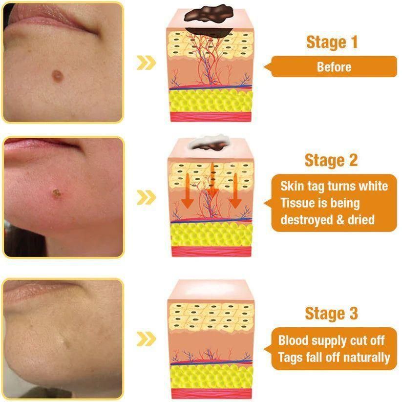 Bee Venom Wart Remover Spray 30ml (Pack of 2)