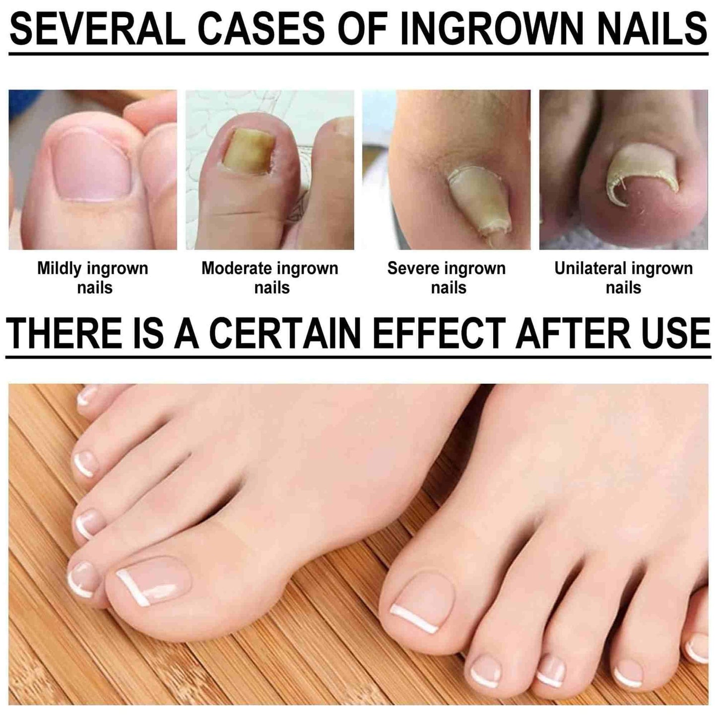 Zidella Ingrown Toenail Drops ? Soften Nail & Pain Reliever (30ml) (Pack of 1)