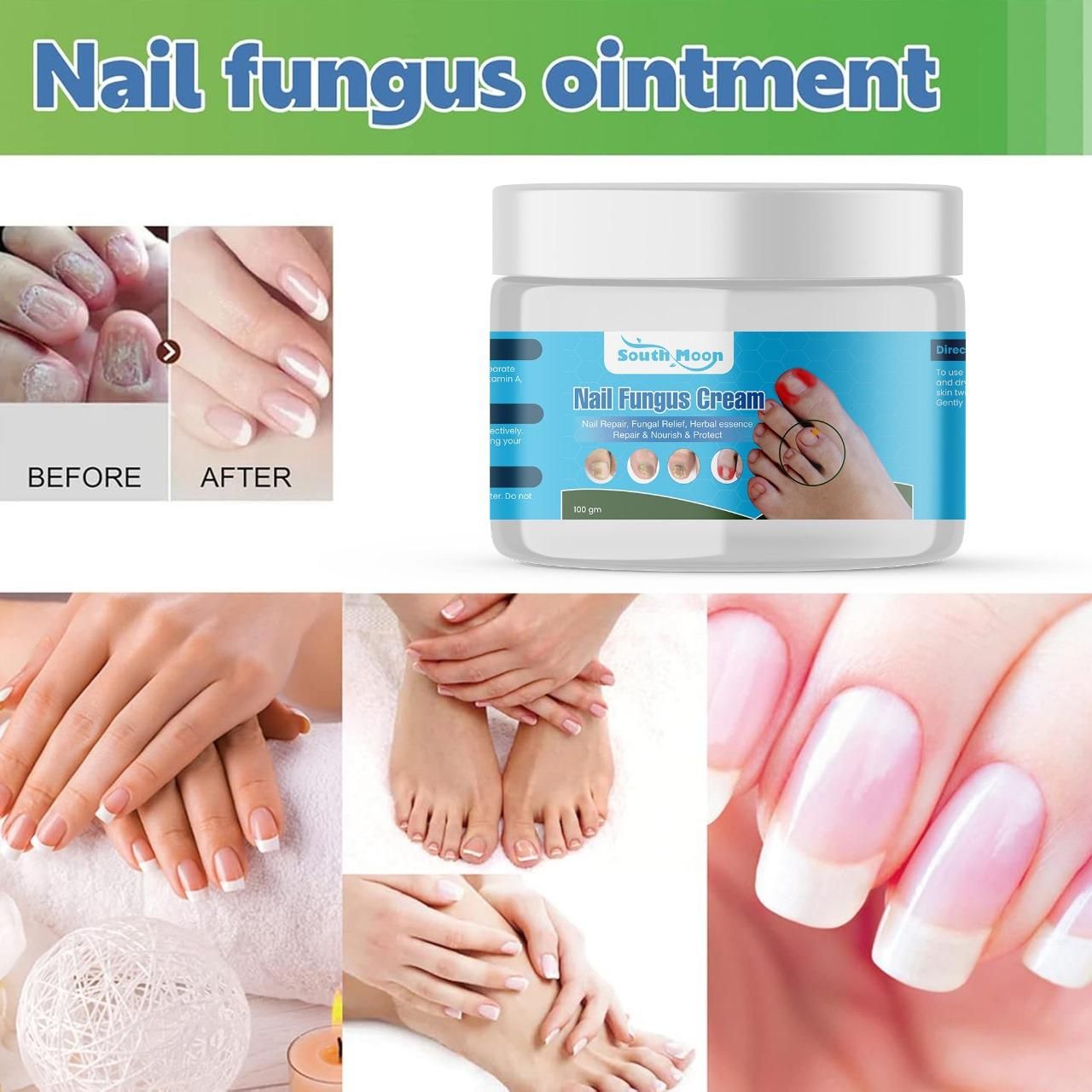 Nail Fungus Treatment Cream 100gm (Pack Of 1)