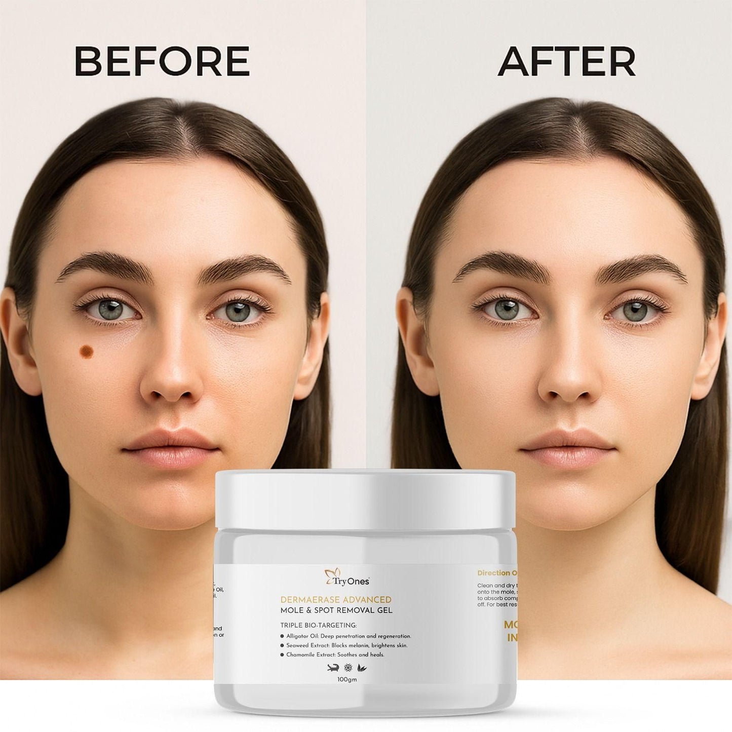 Mole and Spot Removal Gel 200 gm Pack of 2