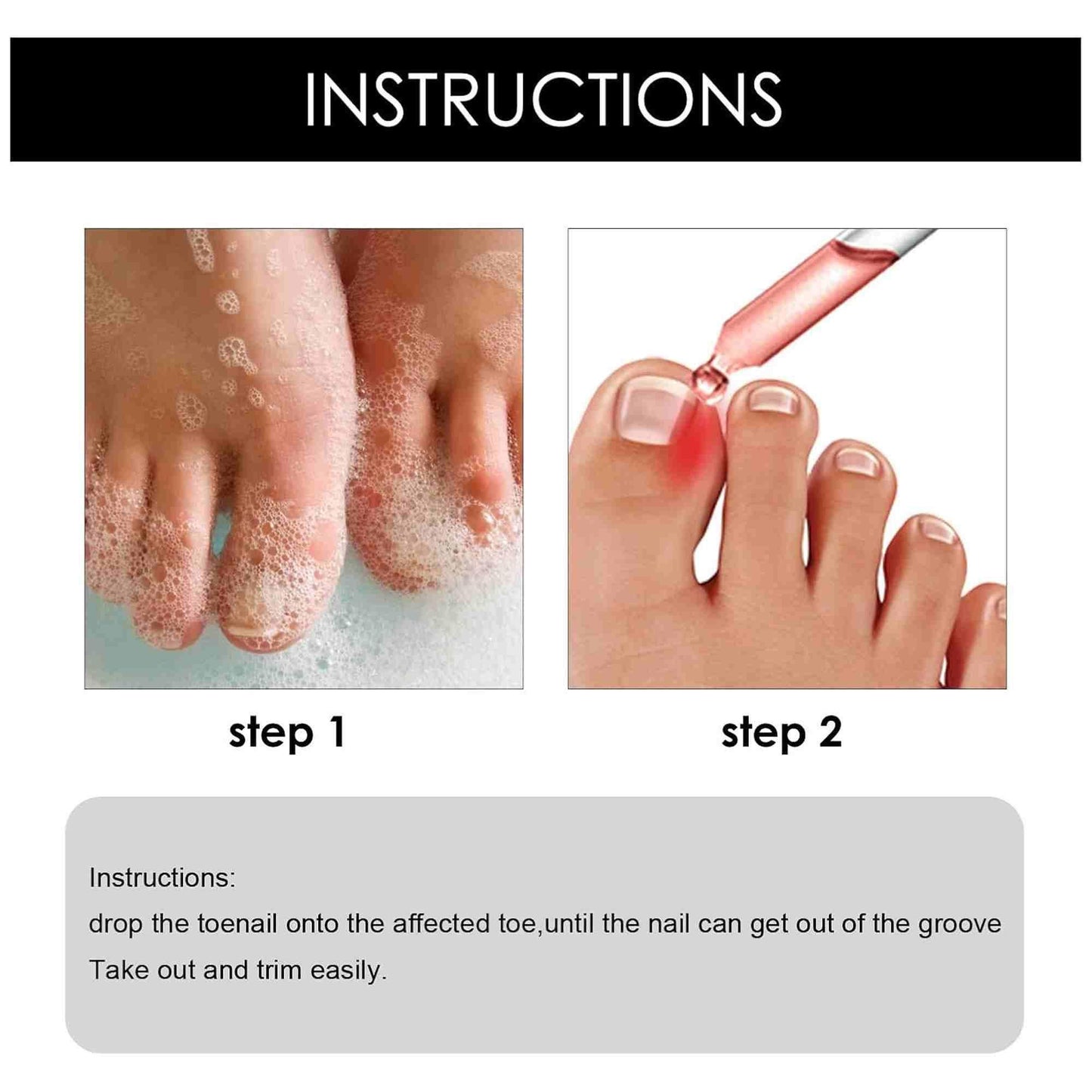 Zidella Ingrown Toenail Drops ? Soften Nail & Pain Reliever (30ml) (Pack of 1)