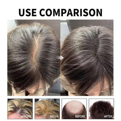 Hair Loss Treatment Serum 30Ml (Pack Of 1)