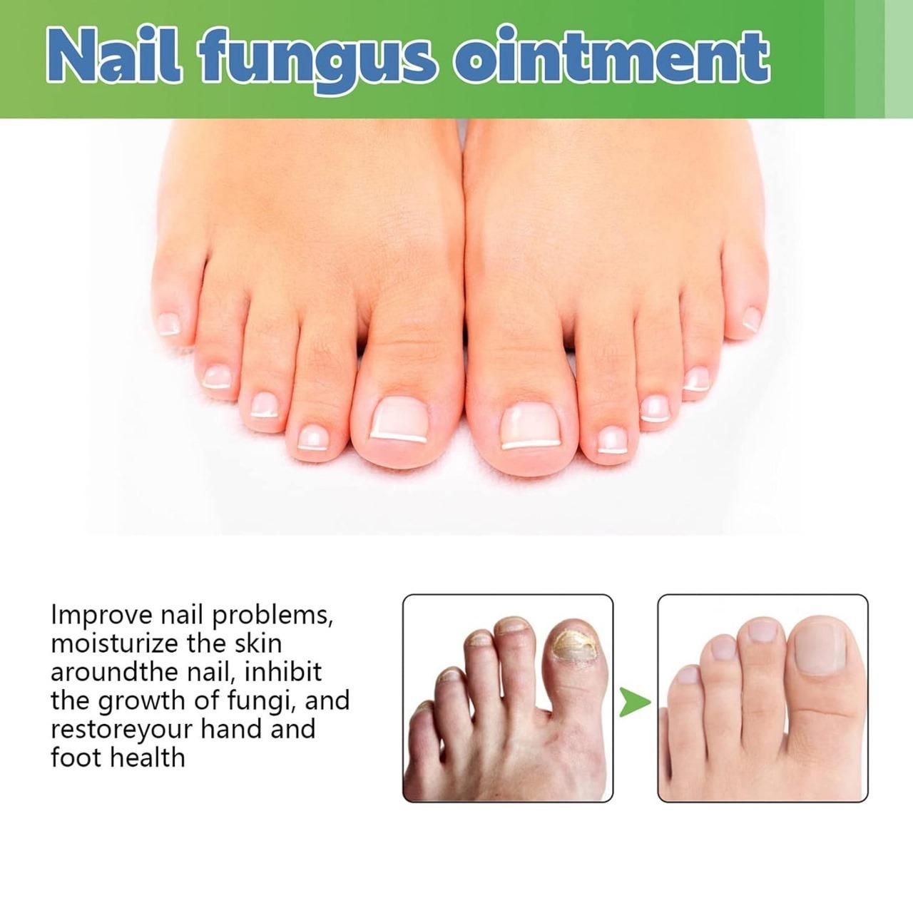Nail Fungus Treatment Cream 100gm (Pack Of 1)